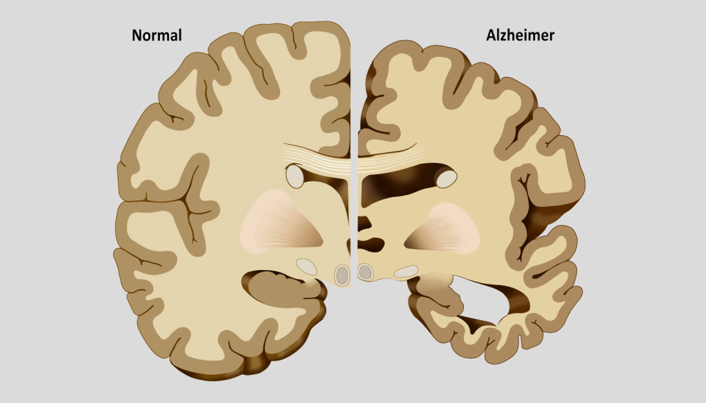Alzheimer'sız bir gelecek için zihninizi güçlendirin, beyninizi Akdeniz diyetiyle besleyin ve düzenli egzersiz yapın.